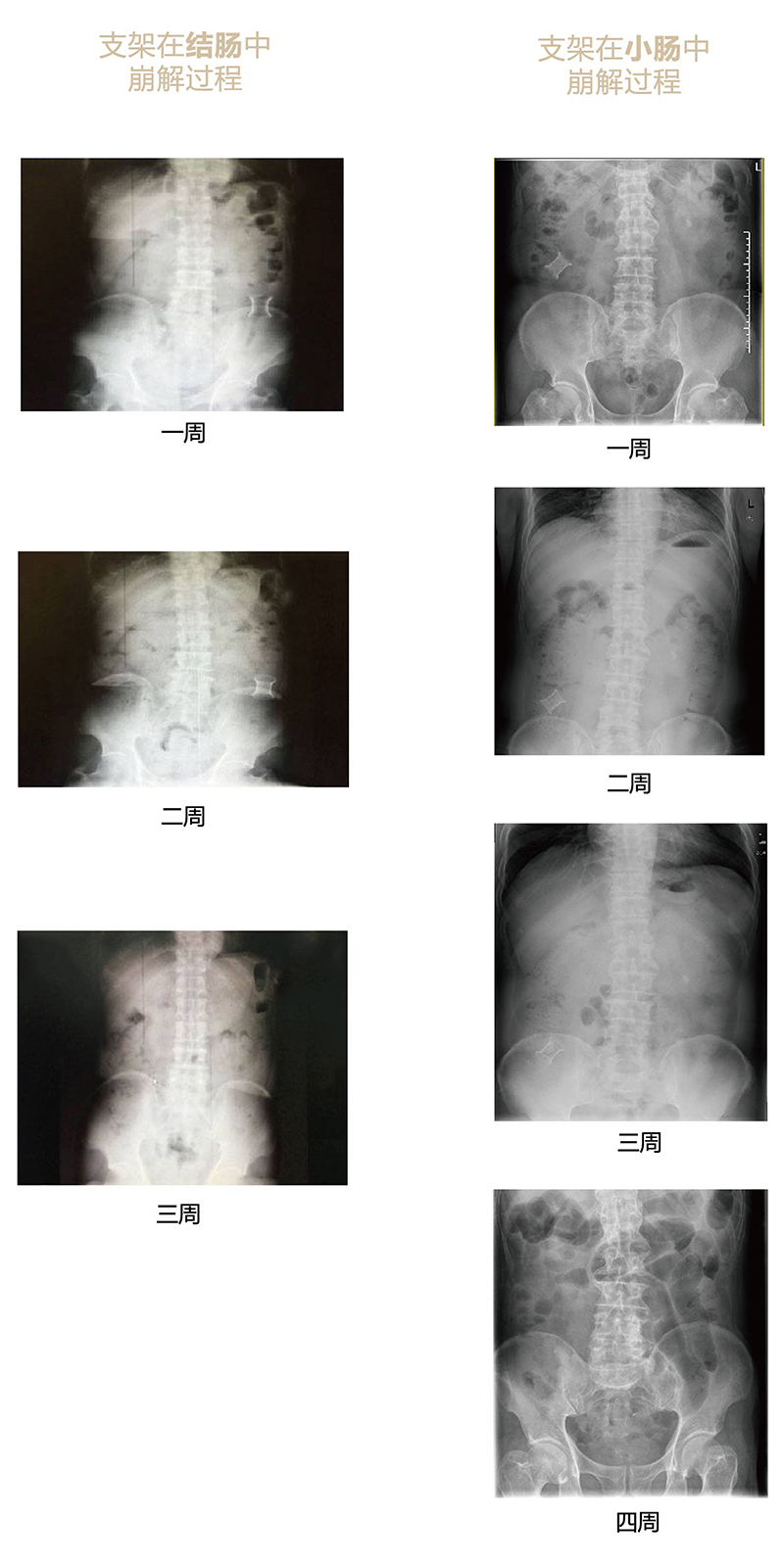 手術(shù)崩解過程x光片-01.jpg